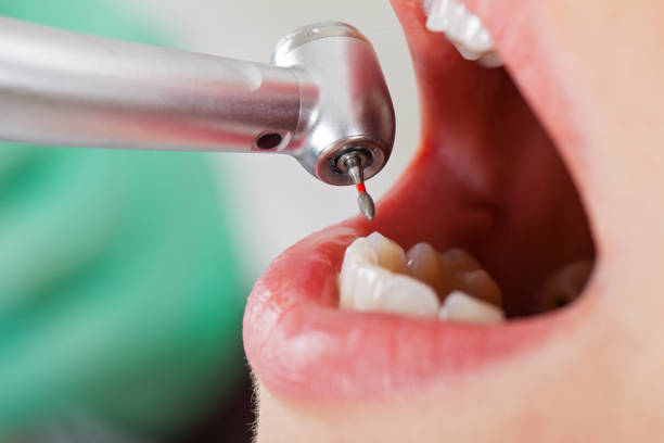 Best Emergency Tooth Extraction in Shawneeland, VA